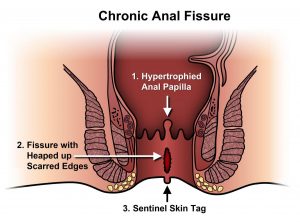 Chronic Anal Fissure