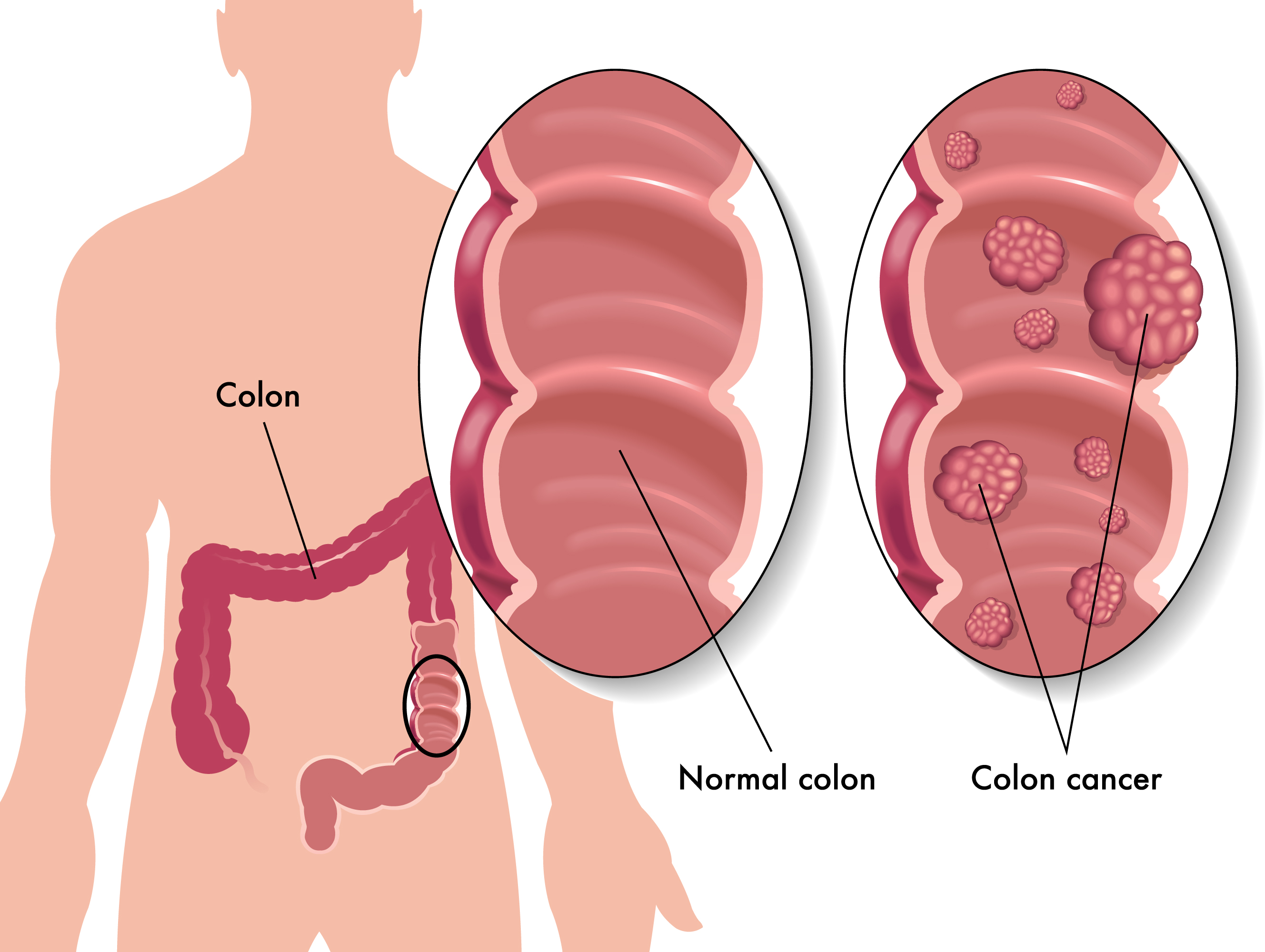 Diagnosis of colorectal cancer
