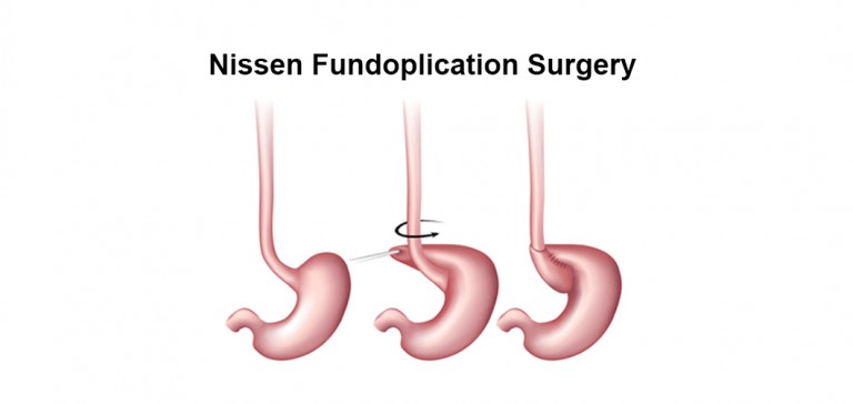 Nissen Fundoplication Surgery