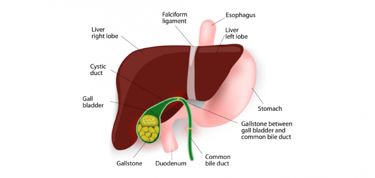 Why is it advised to remove gall bladder when patients suffer from gall bladder stones