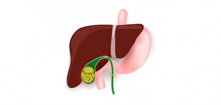 how are gallstones treated